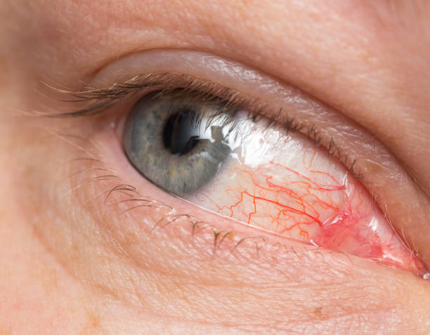 istock Chronic conjunctivitis eye with a red iris and pus close-up 845818072