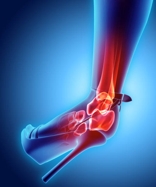 istock Ankle high heeled painful - skeleton x-ray. 846074520