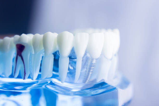 istock Dental tooth dentistry student learning teaching model showing teeth, roots, gums, gum disease, tooth decay and plaque. 846078594