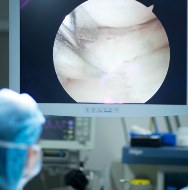 istock Arthroscopy surgery screen showing arthroscope camera picture in knee meniscus surgical operation to repair injury 846127048