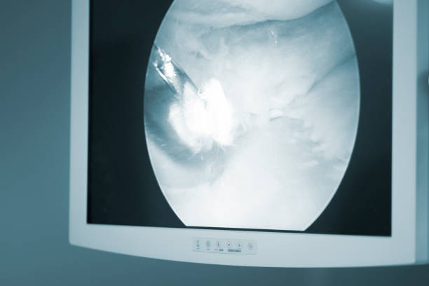 istock Arthroscopy surgery screen showing arthroscope camera picture in knee meniscus surgical operation to repair injury 846127110