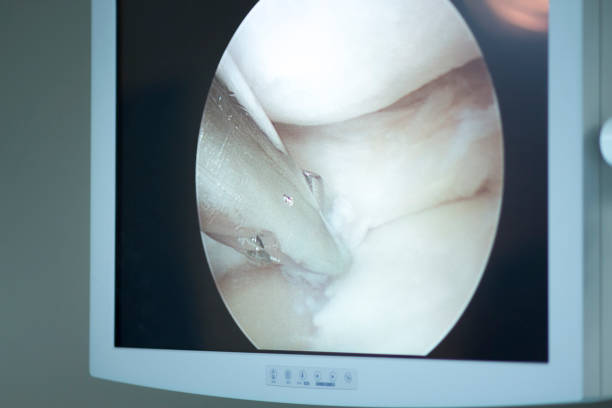 istock Arthroscopy surgery screen showing arthroscope camera picture in knee meniscus surgical operation to repair injury 846127118