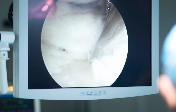 istock Arthroscopy surgery screen showing arthroscope camera picture in knee meniscus surgical operation to repair injury 846127144