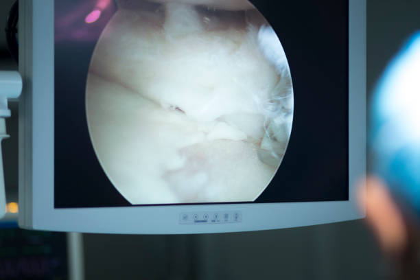 istock Arthroscopy surgery screen showing arthroscope camera picture in knee meniscus surgical operation to repair injury 846127164