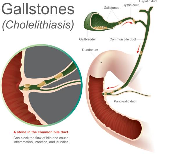 Gallstones cholelithiasis A stone in the common bile duct, gallstones can block the flow of bile and cause inflammation infection and jaundice, Info graphic Vector. gall bladder stock illustrations