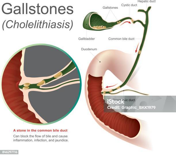 Gallstones Cholelithiasis Stock Illustration - Download Image Now - Gall Stone, Gall Bladder, Duct