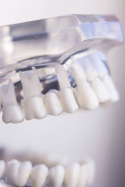 istock Dentists tooth plastic model with screw implant for teaching, learning and patients in dental office showing teeth and gums. 846314228