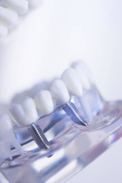 istock Dentists tooth plastic model with screw implant for teaching, learning and patients in dental office showing teeth and gums. 846314256