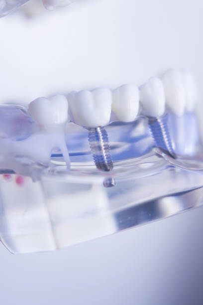istock Dentists tooth plastic model with screw implant for teaching, learning and patients in dental office showing teeth and gums. 846314260