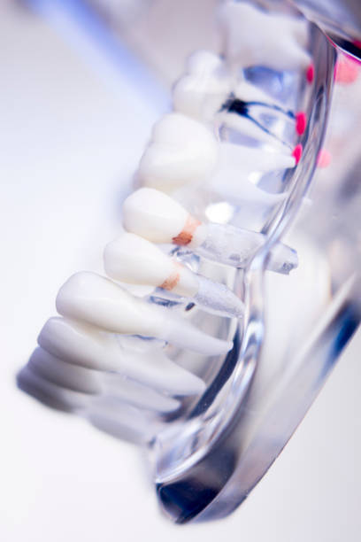 istock Dentists tooth plastic model with screw implant for teaching, learning and patients in dental office showing teeth and gums. 846314344