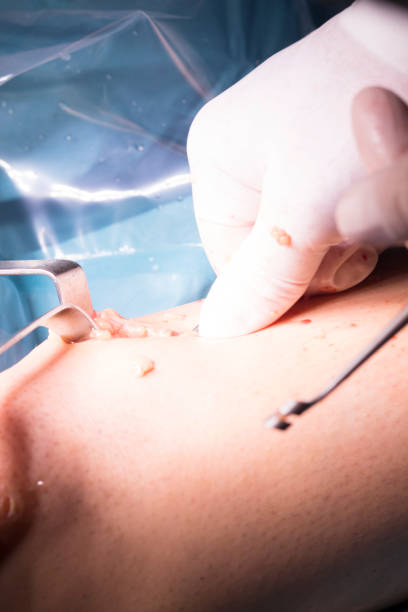 istock Surgical operation knee arthroscopy micro surgery on knee, tendon, ligament and meniscus  in hospital operating theater emergency room. 846324466