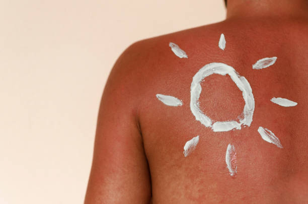 istock Skin sun burn on sea 846543192