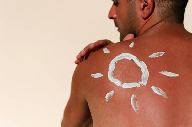 Sun burn male skin
