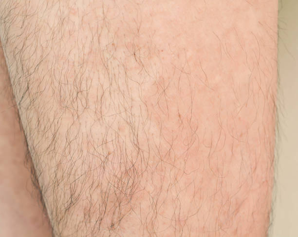 istock Psoriasis on the skin 846600200