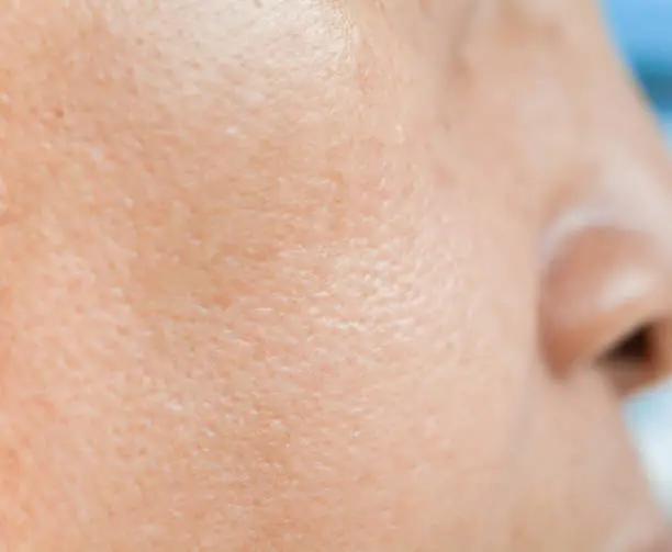 Pores on the face in women