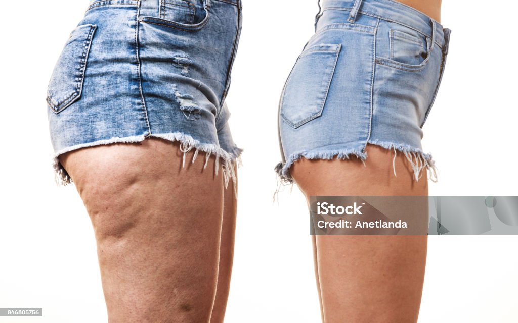 Comparison of legs with and without cellulite Comparison of female legs thighs with and without cellulite. Skin problem, body care, overweight and dieting concept. Cellulite Stock Photo