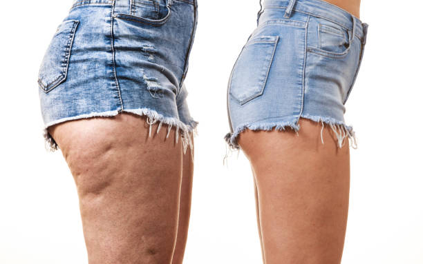 Comparison of legs with and without cellulite Comparison of female legs thighs with and without cellulite. Skin problem, body care, overweight and dieting concept. cellulite stock pictures, royalty-free photos & images