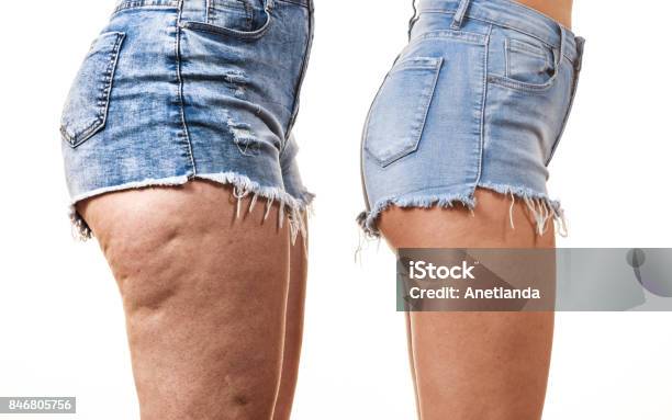 Comparison Of Legs With And Without Cellulite Stock Photo - Download Image Now - Cellulite, Leg, Healthcare And Medicine