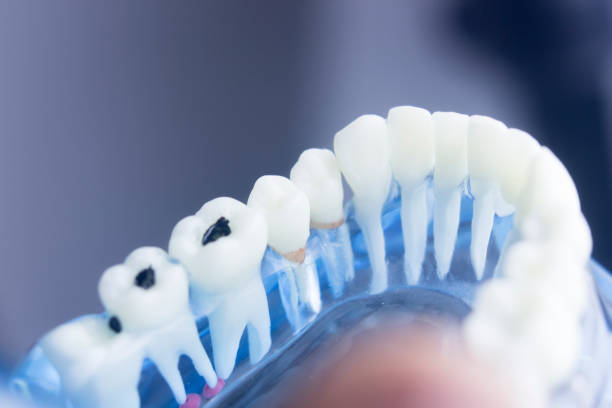 istock Dental tooth dentistry student learning teaching model showing teeth, roots, gums, gum disease, tooth decay and plaque. 846896306