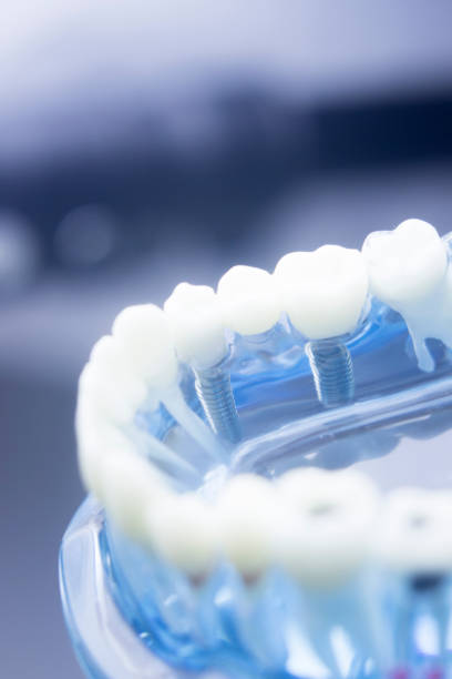 istock Dental tooth dentistry student learning teaching model showing teeth, roots, gums, gum disease, tooth decay and plaque. 846896318