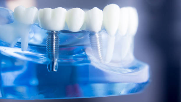istock Dental tooth dentistry student learning teaching model showing teeth, roots, gums, gum disease, tooth decay and plaque. 846896338