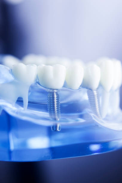 istock Dental tooth dentistry student learning teaching model showing teeth, roots, gums, gum disease, tooth decay and plaque. 846896344