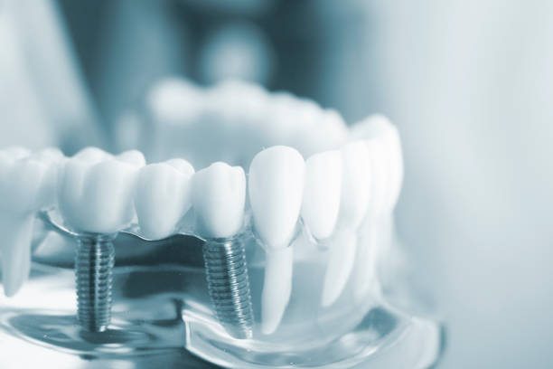istock Dental tooth dentistry student learning teaching model showing teeth, roots, gums, gum disease, tooth decay and plaque. 846896364