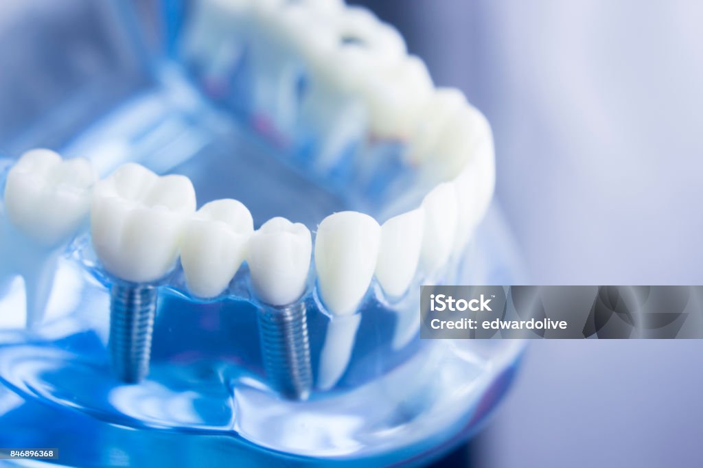 Dental Zahn Zahnmedizin Lernerfolge Lehrmodell zeigt Zähne, Wurzeln, Zahnfleisch, Zahnfleischerkrankungen, Karies und Plaque. - Lizenzfrei Zahnimplantat Stock-Foto