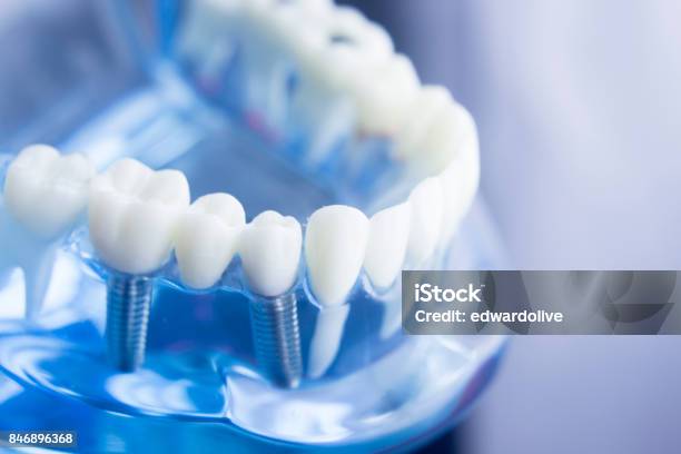 Dental Zahn Zahnmedizin Lernerfolge Lehrmodell Zeigt Zähne Wurzeln Zahnfleisch Zahnfleischerkrankungen Karies Und Plaque Stockfoto und mehr Bilder von Zahnimplantat
