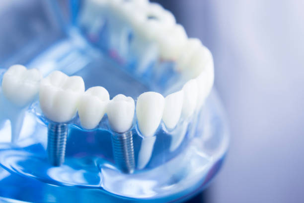 dental tooth dentistry student learning teaching model showing teeth, roots, gums, gum disease, tooth decay and plaque. - dental implant dental hygiene dentures prosthetic equipment imagens e fotografias de stock