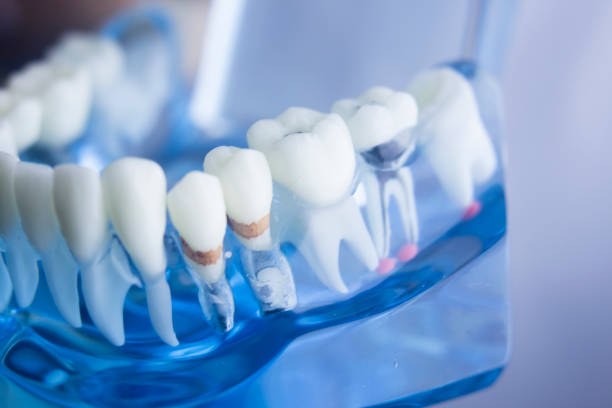 istock Dental tooth dentistry student learning teaching model showing teeth, roots, gums, gum disease, tooth decay and plaque. 846896452