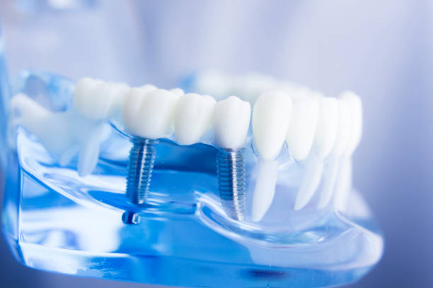 istock Dental tooth dentistry student learning teaching model showing teeth, roots, gums, gum disease, tooth decay and plaque. 846896516