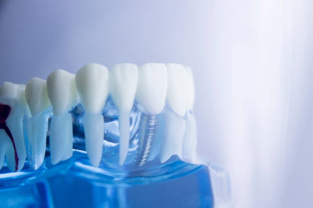 istock Dental tooth dentistry student learning teaching model showing teeth, roots, gums, gum disease, tooth decay and plaque. 846932840