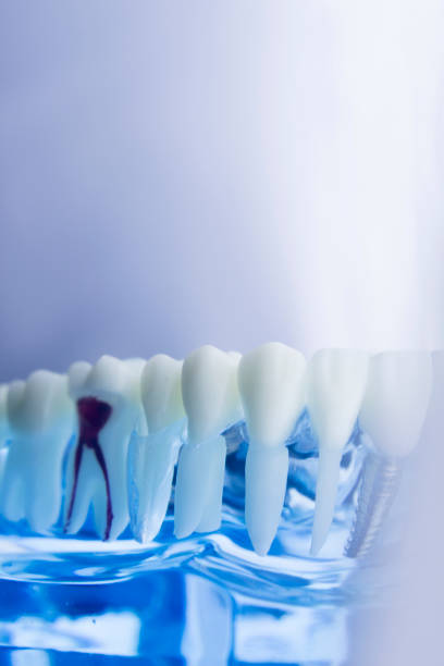 istock Dental tooth dentistry student learning teaching model showing teeth, roots, gums, gum disease, tooth decay and plaque. 846932926