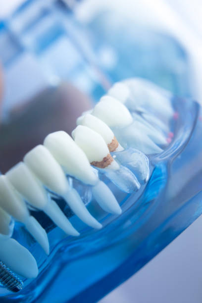 istock Dental tooth dentistry student learning teaching model showing teeth, roots, gums, gum disease, tooth decay and plaque. 846933032