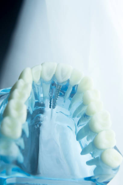 istock Dental tooth dentistry student learning teaching model showing teeth, roots, gums, gum disease, tooth decay and plaque. 846933084