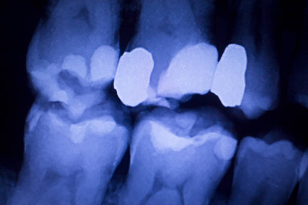 istock Dentists dental teeth x-ray showing tooth fillings. 846940746