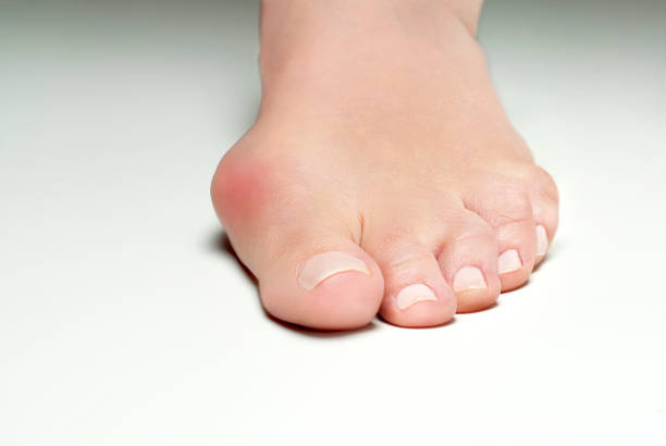 外反母趾、ホワイト バック グラウンドに足を女性の腱膜瘤 - misalignment ストックフォトと画像