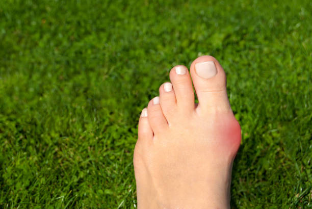 oignon valgu, hallux en pied de femme sur fond d’herbe - misalignment photos et images de collection