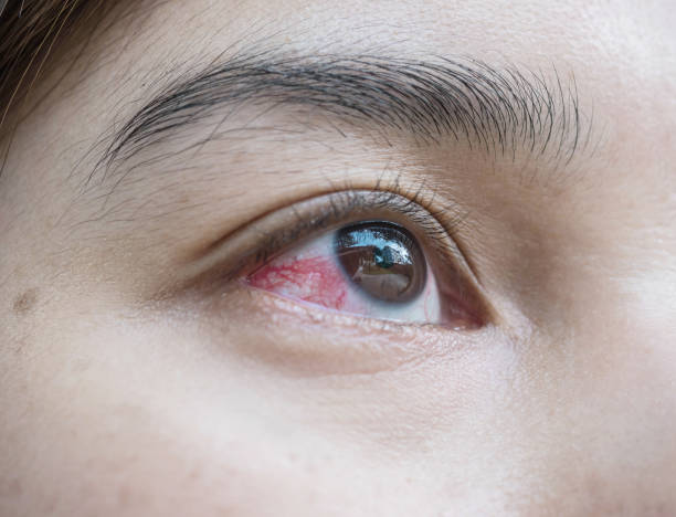 Closeup eye of asian woman with broken capillaries in the eye Closeup eye of asian woman with broken capillaries in the eye ugly people crying stock pictures, royalty-free photos & images