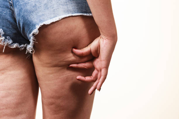셀 룰 라이트 피부 여자 다리 - women human leg body buttocks 뉴스 사진 이미지