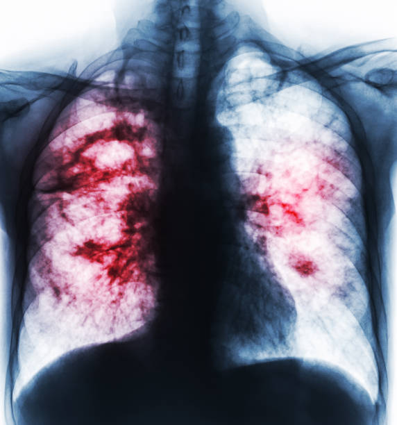 gruźlica płuc . film x-ray klatki piersiowej pokazać jamy w prawym płucu i śródmiąższowe nacieki obu płuc z powodu zakażenia gruźlicą - interstitial zdjęcia i obrazy z banku zdjęć