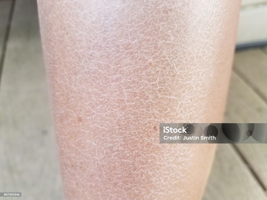 a woman's dry flaky itchy legs close up of a woman's dry flaky itchy legs Skin Stock Photo