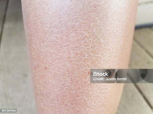 A Womans Dry Flaky Itchy Legs Stock Photo - Download Image Now - Skin, Dry, Rough