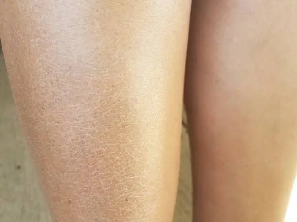 close up of a woman's dry flaky itchy legs