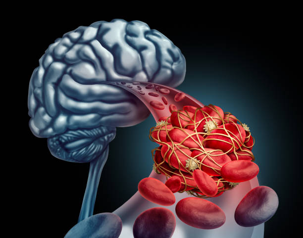 Blood Clot Brain Blood clot brain medical concept as 3D illustration blood cells blocked by an artery blockage thrombus causing a blockage of blood flow to the neurology anatomy in a black background. blood clot stock pictures, royalty-free photos & images