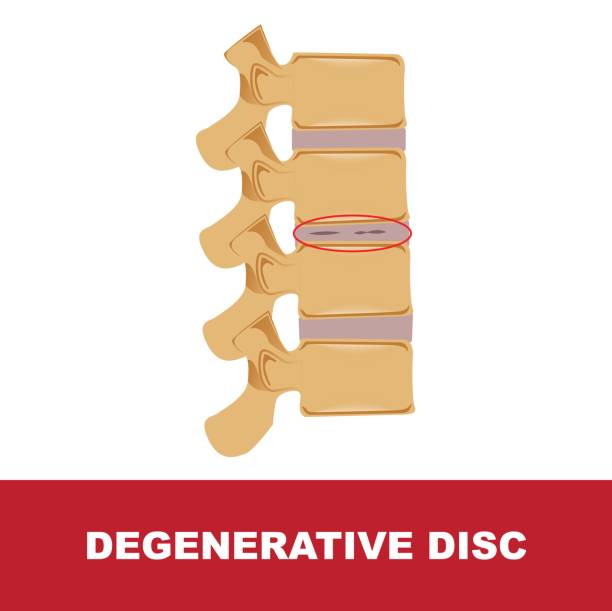 illustrations, cliparts, dessins animés et icônes de discopathie dégénérative - dégénératif