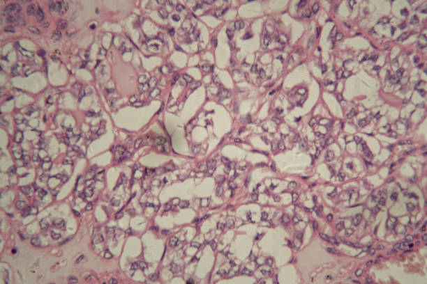 istock Human thyroid gland cells with cancer 848081604