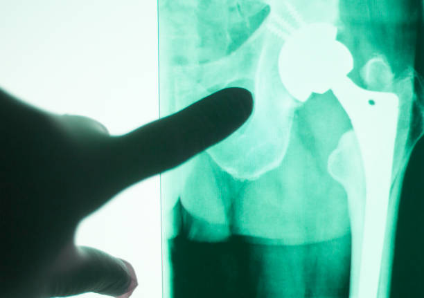 замена тазобедренного сустава impant рентгеновского сканирования результаты сканирования пожилого человека с артритом и суставами боли. - human skeleton body the human body pain стоковые фото и изображения