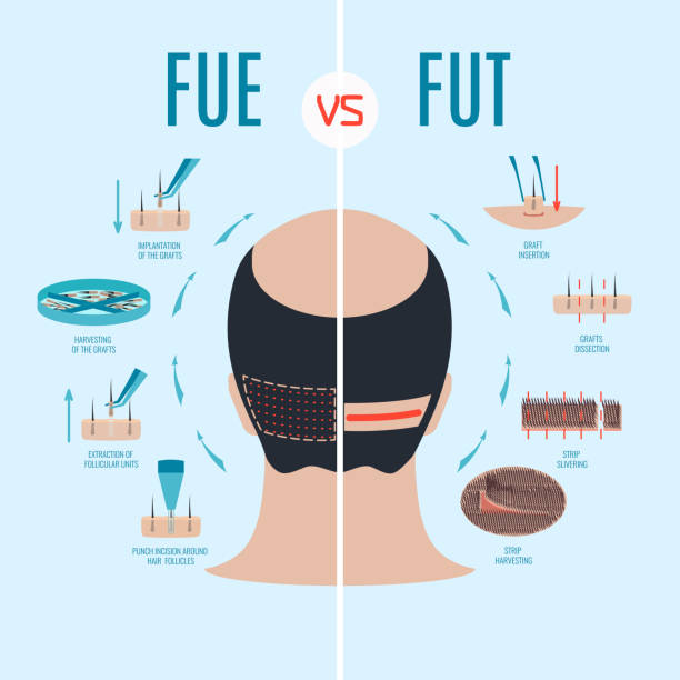 kuvapankkikuvitukset aiheesta fue vs fut - receding hairline